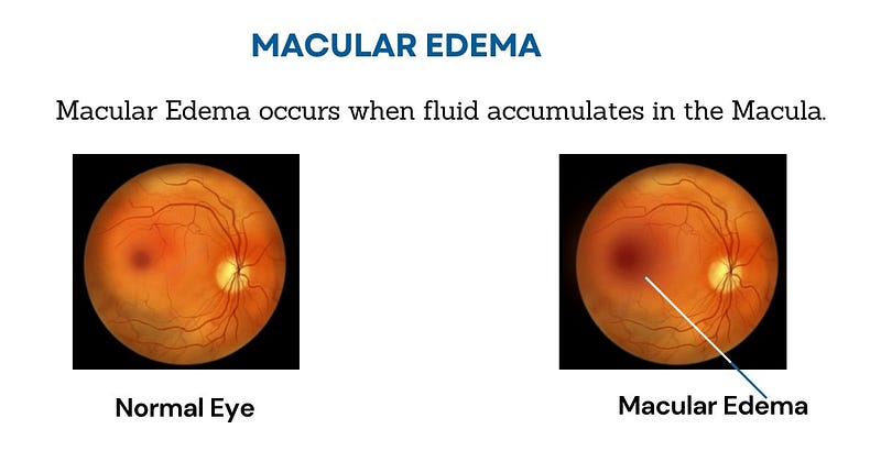 What is Macular Edema