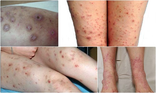 Obat Pururigo Di Apotik 100% Alami Dan Ampuh