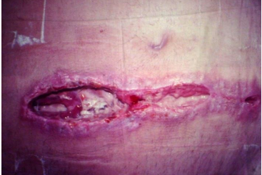 imagem de uma ferida contaminada