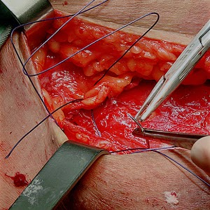 ferida aberta com fio de sutura