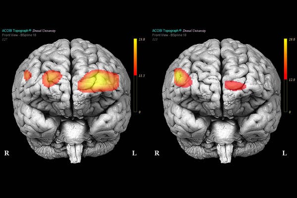 Multiple Personality Disorder Brain Vs Normal Brain