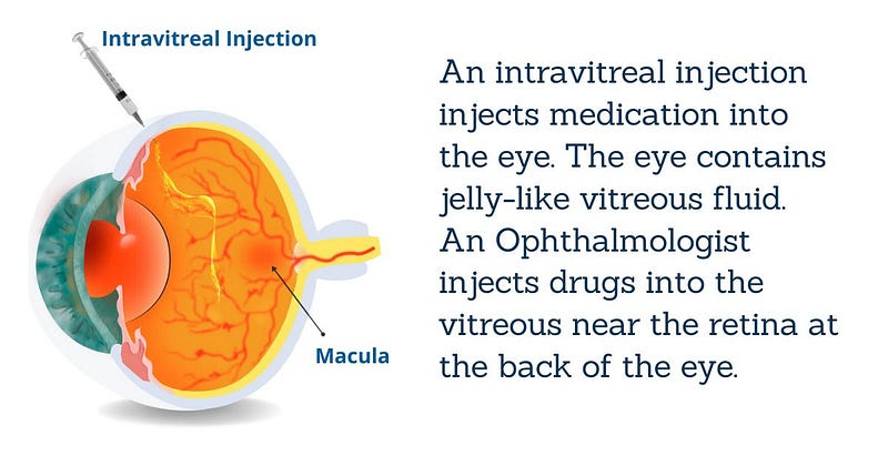 Intravitreal Injections for Macular Edema Treatment