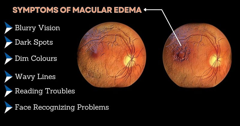 Symptoms of Macular Edema