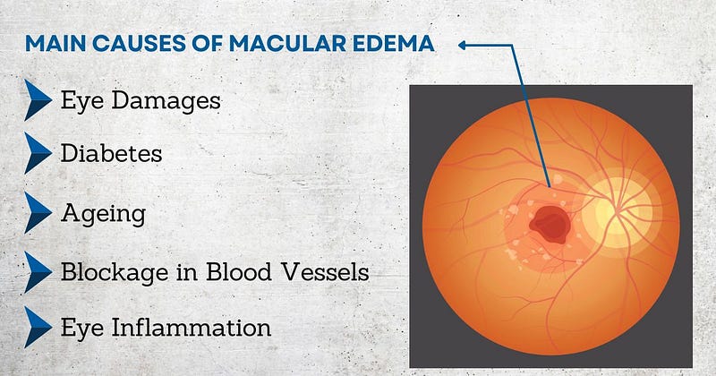 Causes of Macular Edema