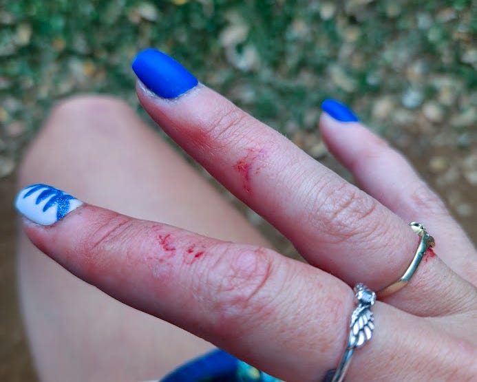 The middle and ring finger of a woman’s right hand with a semicircular bite mark between the second and third knuckles, red from bleeding slightly.