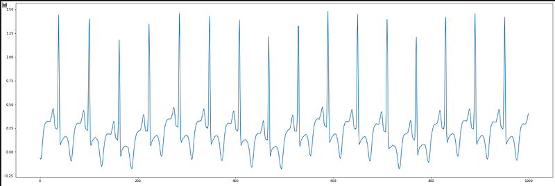 ECG Channel 2 Signal
