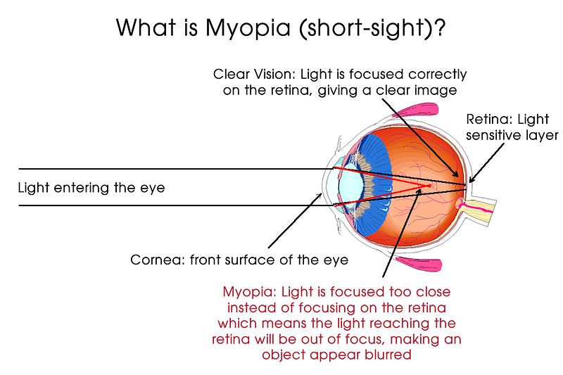 What Does It Mean To Be Short Sighted myopic Finchley s Multi