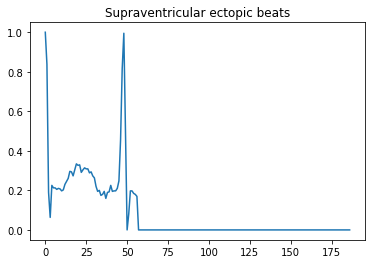 Supraventricular ectopic beats