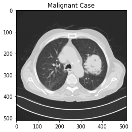 Image of a malignant case CT Scan