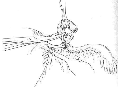 desenho explicando como aplicar clamp num vaso sanguíneo