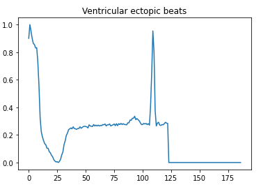 Ventricular ectopic beats