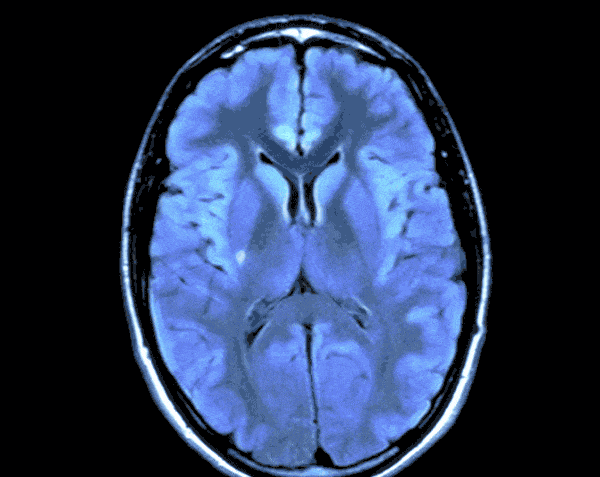 Brain Tumor Detection