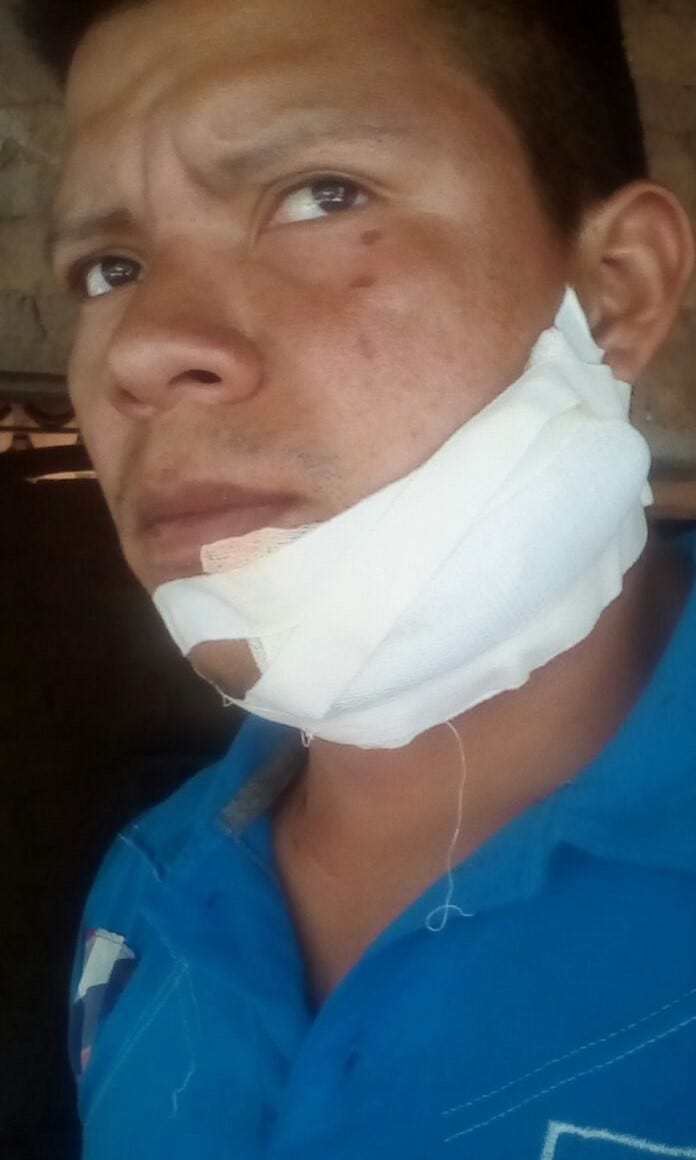 Misael Sanchez, a few weeks after a hooded man chopped his face with a machete following a union meeting near Choluteca, Honduras.