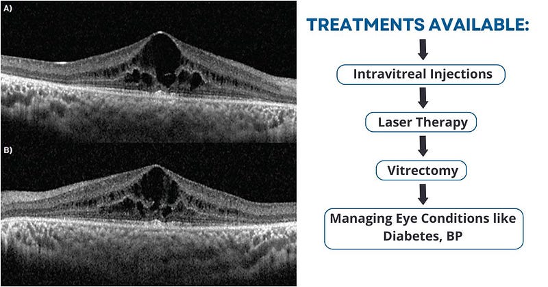 Treatment of Macular Edema in Delhi