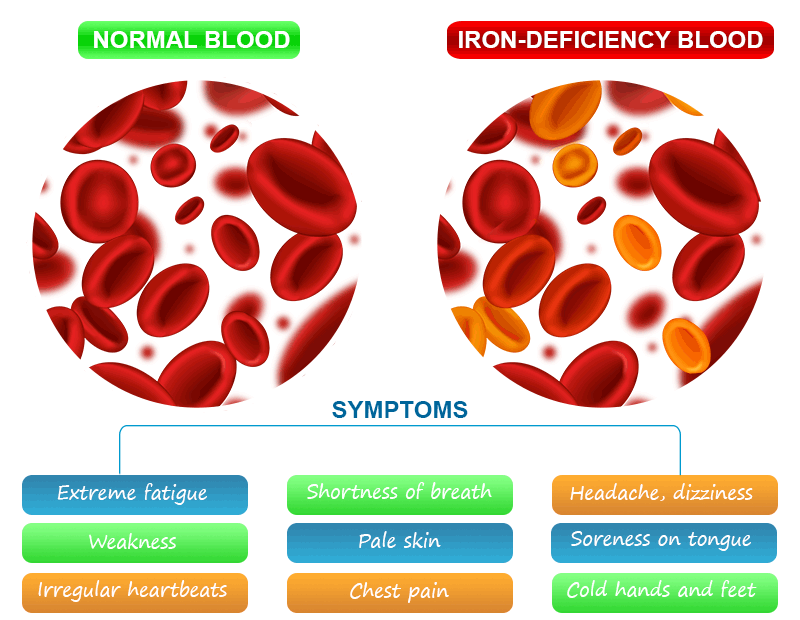 Iron Deficiency Anemia Symptoms, Causes, and Treatment
