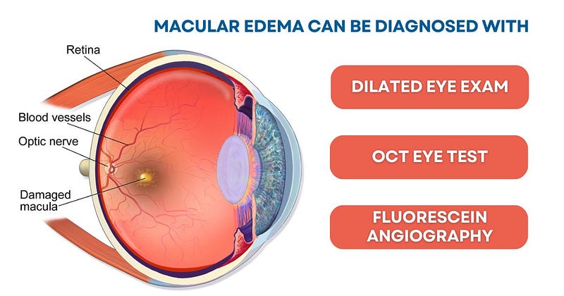 Diagnosis of Macular Edema