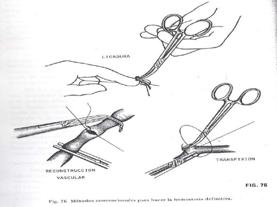 desenho explicando como controlar uma artéria com instrumental cirúrgico