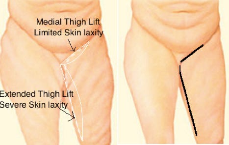 Two different types of thigh lift surgery: medial thigh lift and extended thigh lift.