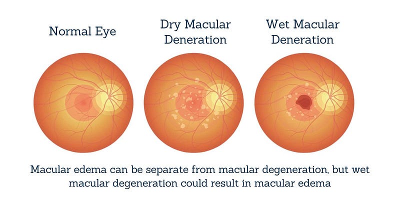 Age-Related Macular Degeneration vs. Macular Edema