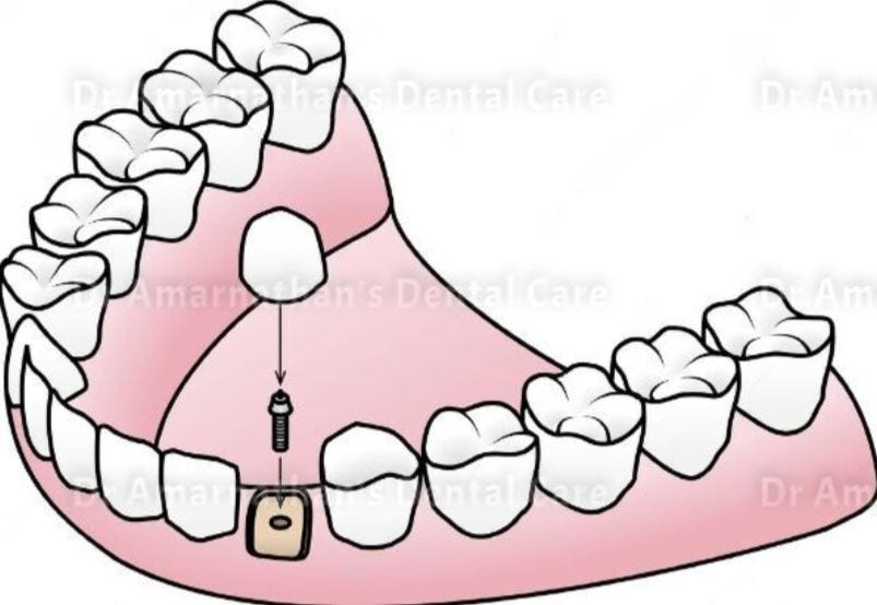 different types of dental implants