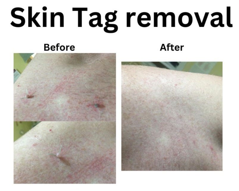 Before and after of skin tag removal
