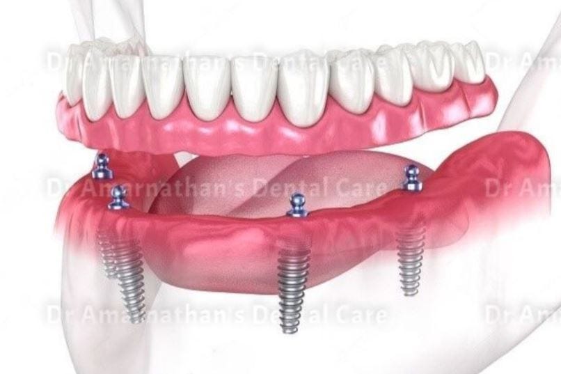 different types of dental implants