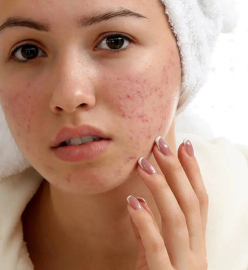 acne scars