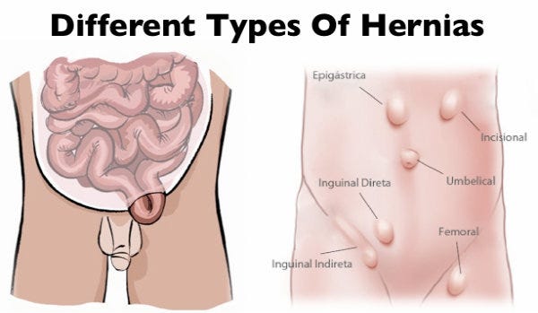 Inguinal hernia: The most common type of hernia in men and women