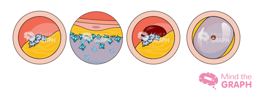 Drug-Coated Balloon (DCB) angioplasty