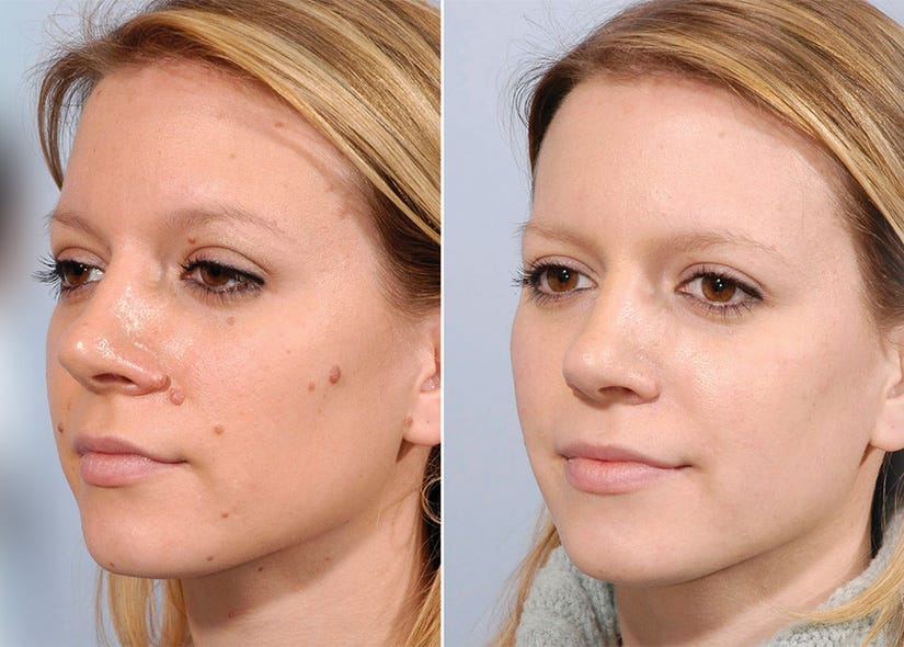 Face before and after mole removal