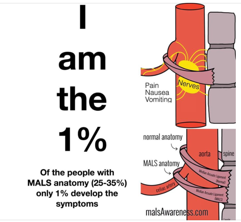 I am the 1% diagnosed with Median Arcuate Ligament Syndrome. Most people have no symptoms or are misdiagnosed.