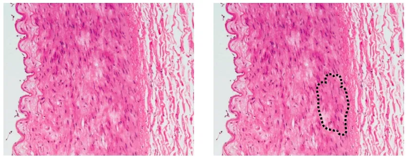 The left panel shows the image fed into an algorithm and the right one shows a patch where dangerous cells can be found and the physician can take a closer look at it.