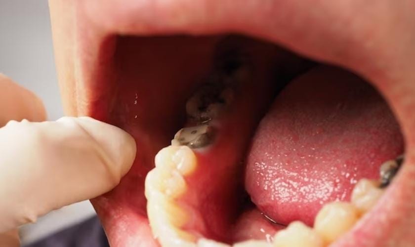 belmont dentistry scottsdale answers what are the signs of sepsis from tooth infection
