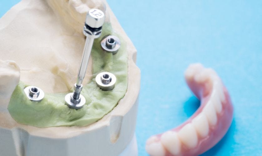 Stay Safe From Any Downsides to Dental Implants in Chandler