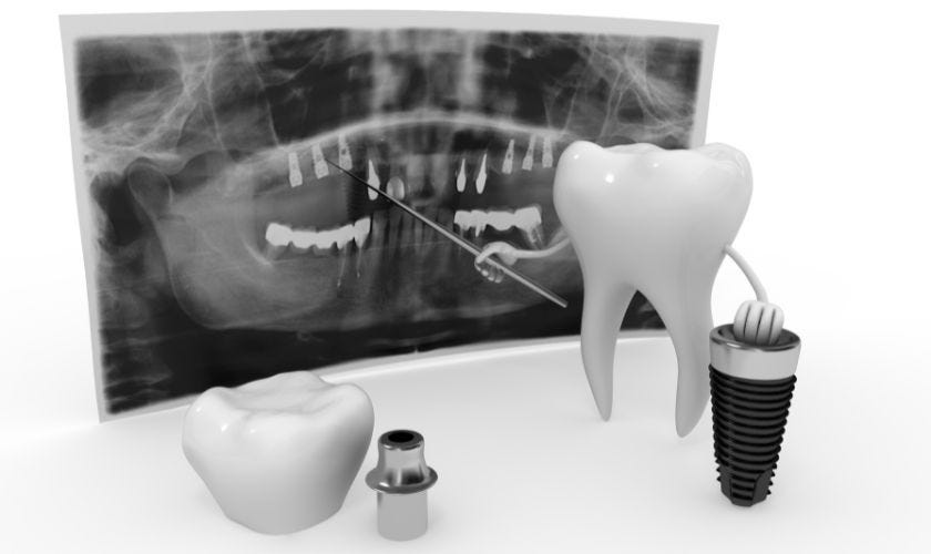 Dental X-Rays to check the placement of Implants with bone density