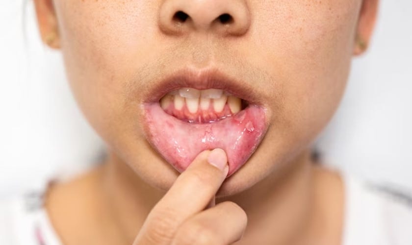 guide to signs of hcv in the mouth by belmont dentistry in scottsdale