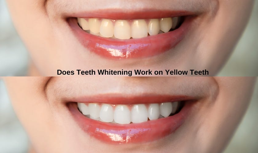 “Explore the effectiveness of teeth whitening on yellow teeth. Learn about professional treatments, dentist techniques, and home remedies. Discover the best options in Millbrae for a radiant smile.”
