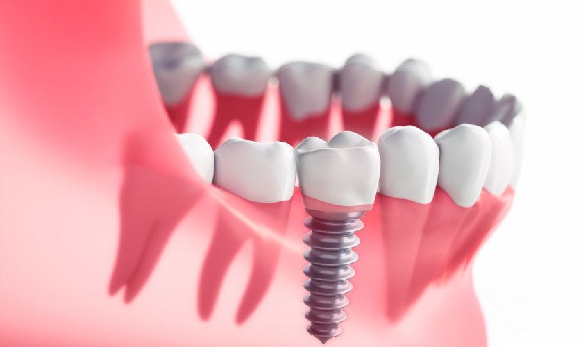 Dental Implants in Rio Rancho