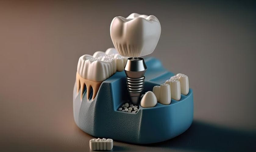 dental implants newport news