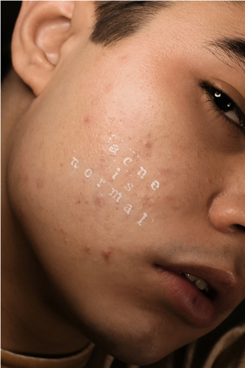 Close up of skin with acne and scars with text that reads: acne is normal