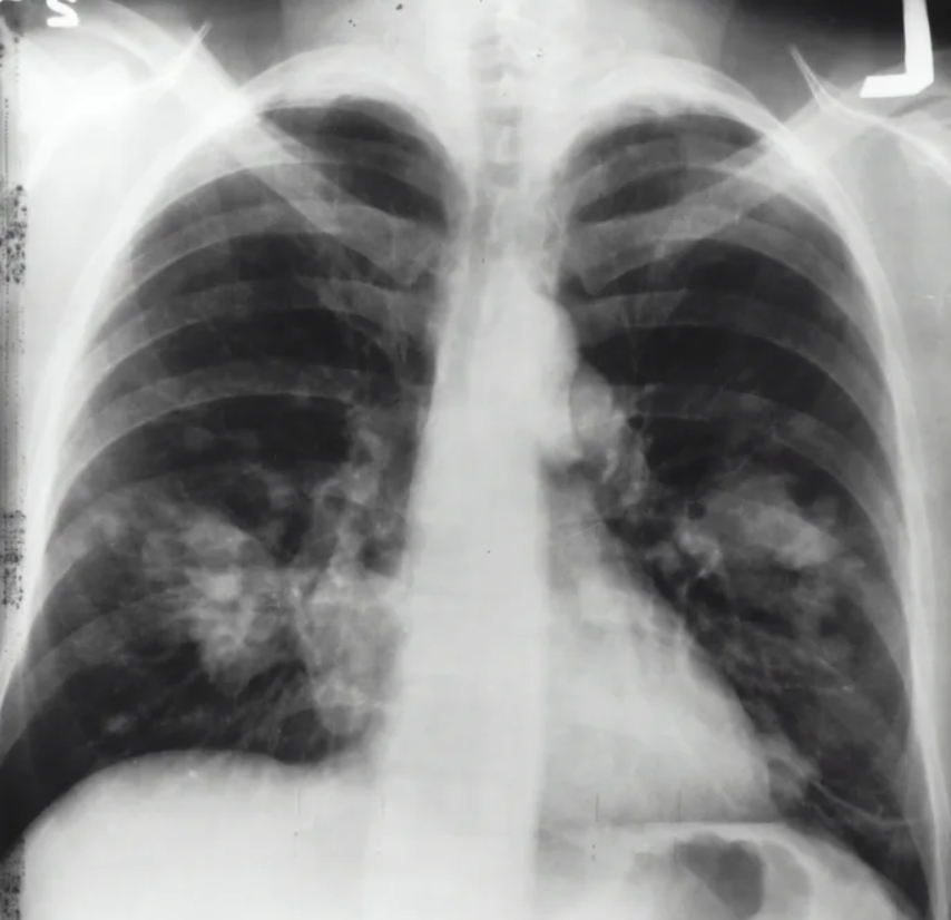 Silver Medal Solution to OSIC Pulmonary Fibrosis Progression