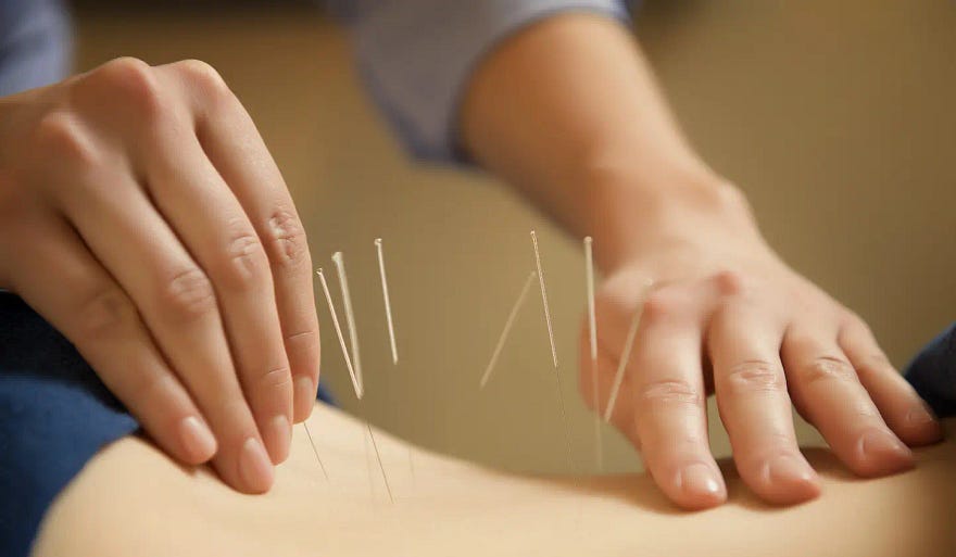 Exploring the Role Of  Physiotherapists in Dry Needling: A Comprehensive Discussion