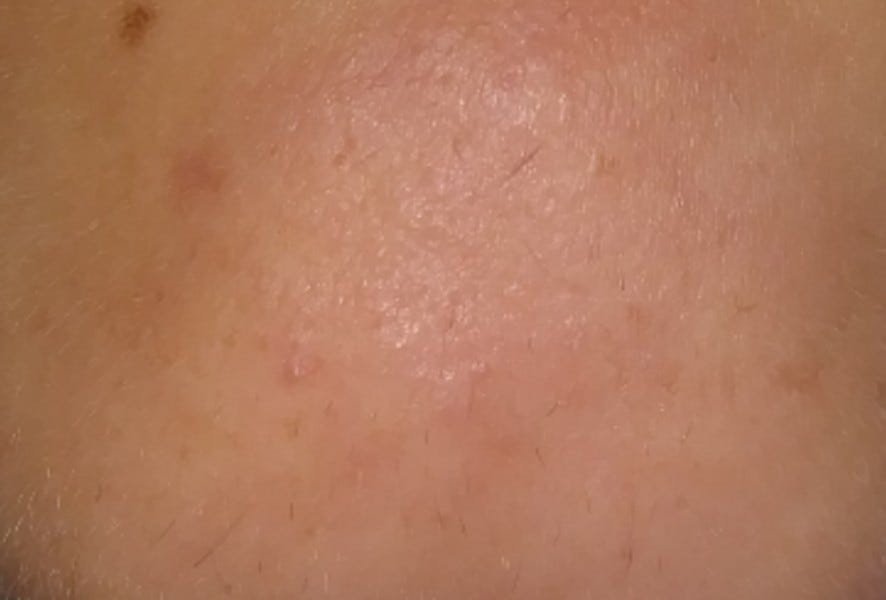 A Slow Respondent Responding To Minoxidil After Daily Retinol After