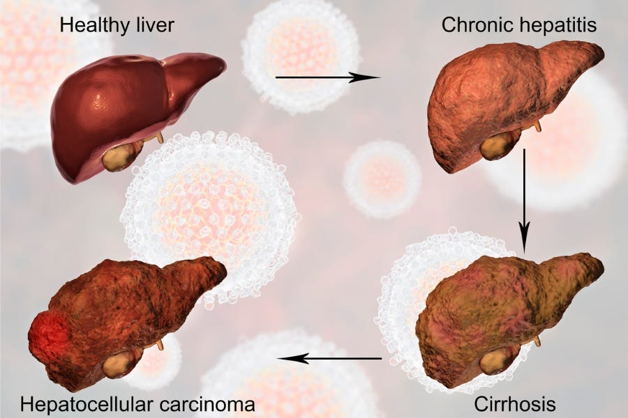 Types of Fatty Liver Disease