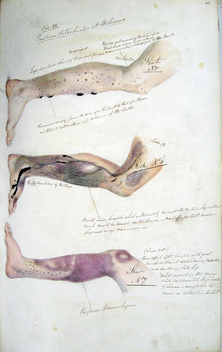 A page from Henry Walsh Mahon’s journal shows scurvy’s effects from his time aboard HM Convict Ship Barrosa. The image shows legs with three progressive stages of the disease and labels showing the lesions. The first leg has black papules; the second shows puffy swelling with dark purple streaks; the third shows blotches of purple ecchymosis (bleeding) in the skin.