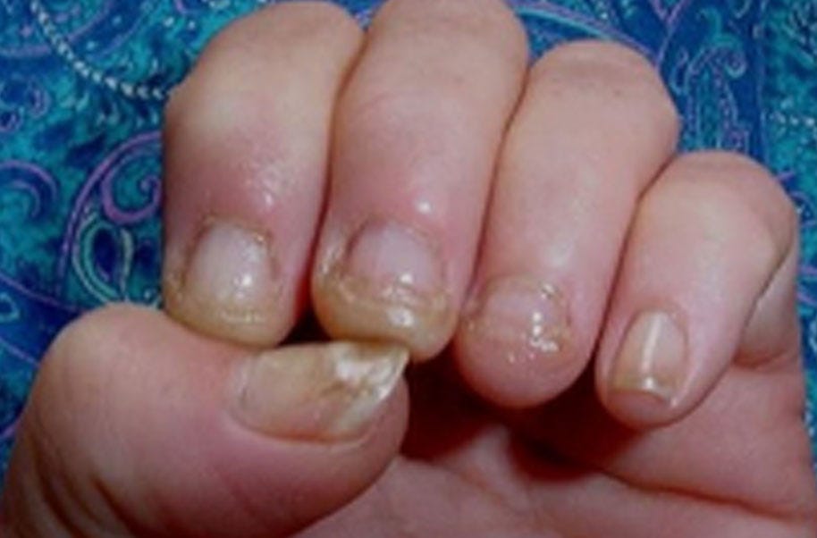 Catch Nail Fungus