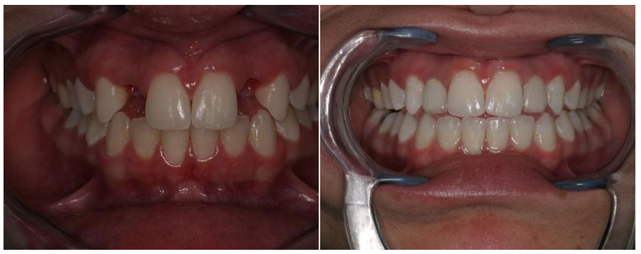 A before and after image of a patient from Aspenwood Dental Associates who had their teeth restored with dental implants