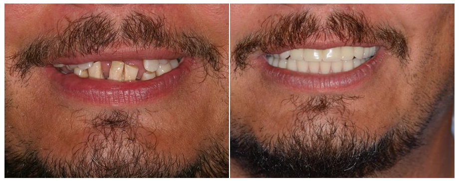 A before and after image of an Aspenwood Dental Associates patient who had dental implants and dentures