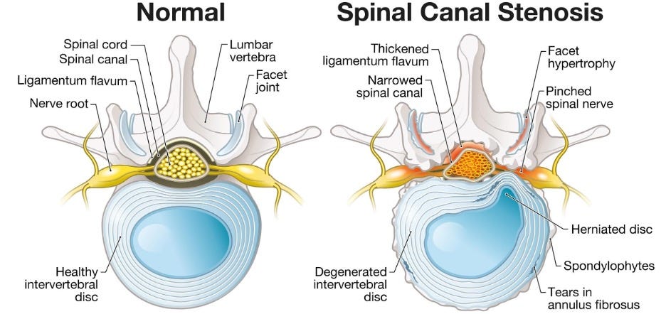 Side-by-side medical illustration comparing a normal spinal canal and a spinal canal affected by stenosis. The left side shows a normal lumbar vertebra with a healthy intervertebral disc, open spinal canal, spinal cord, nerve root, ligamentum flavum, and facet joint. The right side shows spinal canal stenosis with a narrowed spinal canal, thickened ligamentum flavum, facet hypertrophy, pinched spinal nerve, herniated disc, degenerated intervertebral disc, spondylophytes, and tears in the annulus