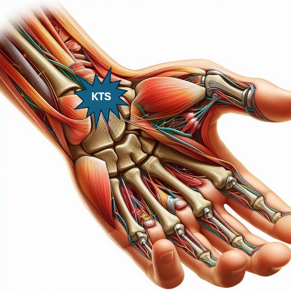 KTS median sinirin el bilek düzeyinde bası altında kalması sonucu ortaya çıkan klinik tablodur.